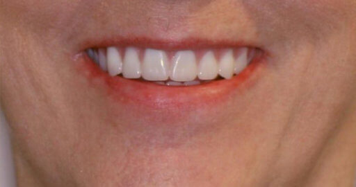 Teeth-4-After
